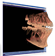 歯科用CT　立体的な診断
